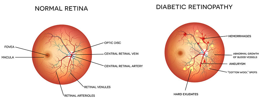 Chart Illustrating a Normal Retina Compared to One With Diabetic Retinopathy